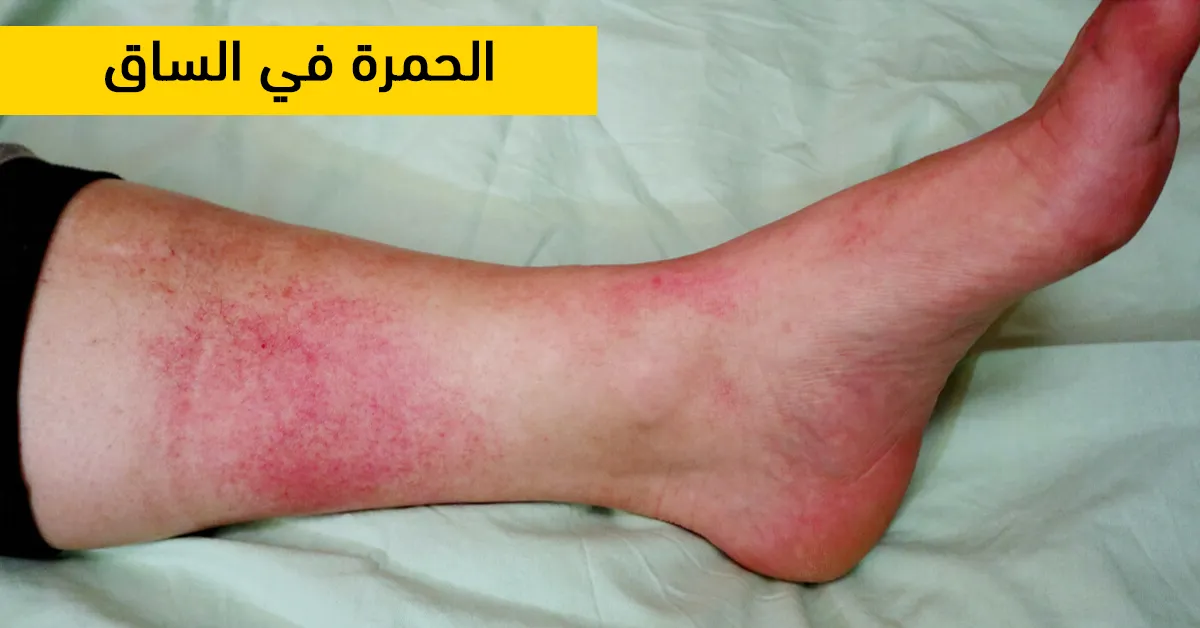 الحمرة في الساق